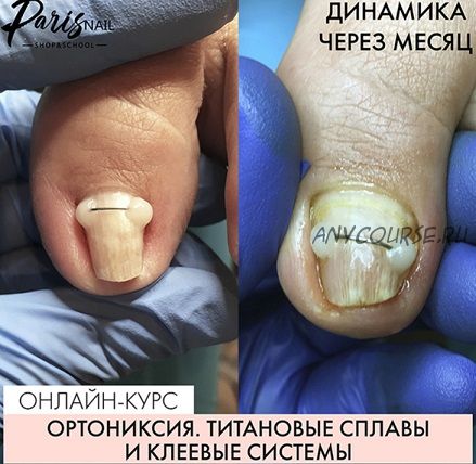 [ParisNail] Ортониксия. Титановые сплавы и клеевые системы (Карина Шурыгина)